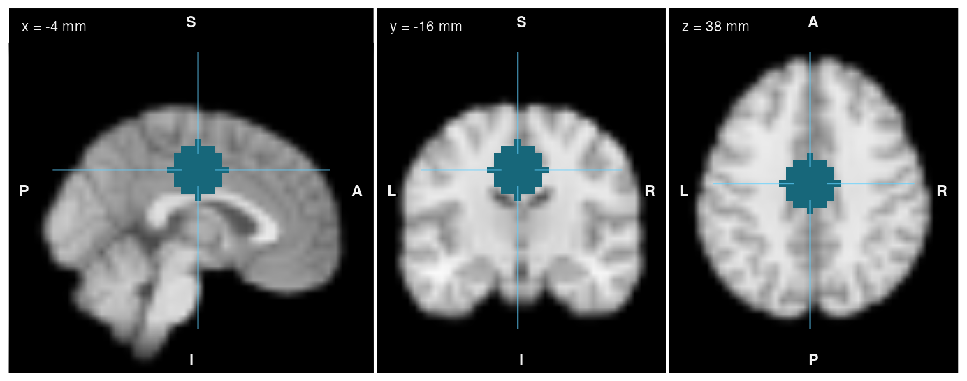 Orthogonal views of the template with a spherical ROI of 16 mm radius highlighted in teal